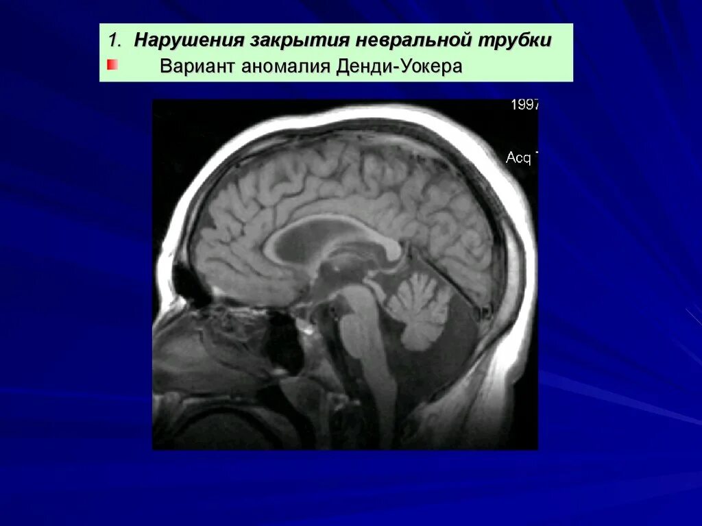 Гипоплазия червя. Гипоплазия мозжечка, аномалия Денди-Уокера. Денди Уокера синдром мрт. Денди-Уокера аномалия мрт. Мальформация Денди Уокера мрт.