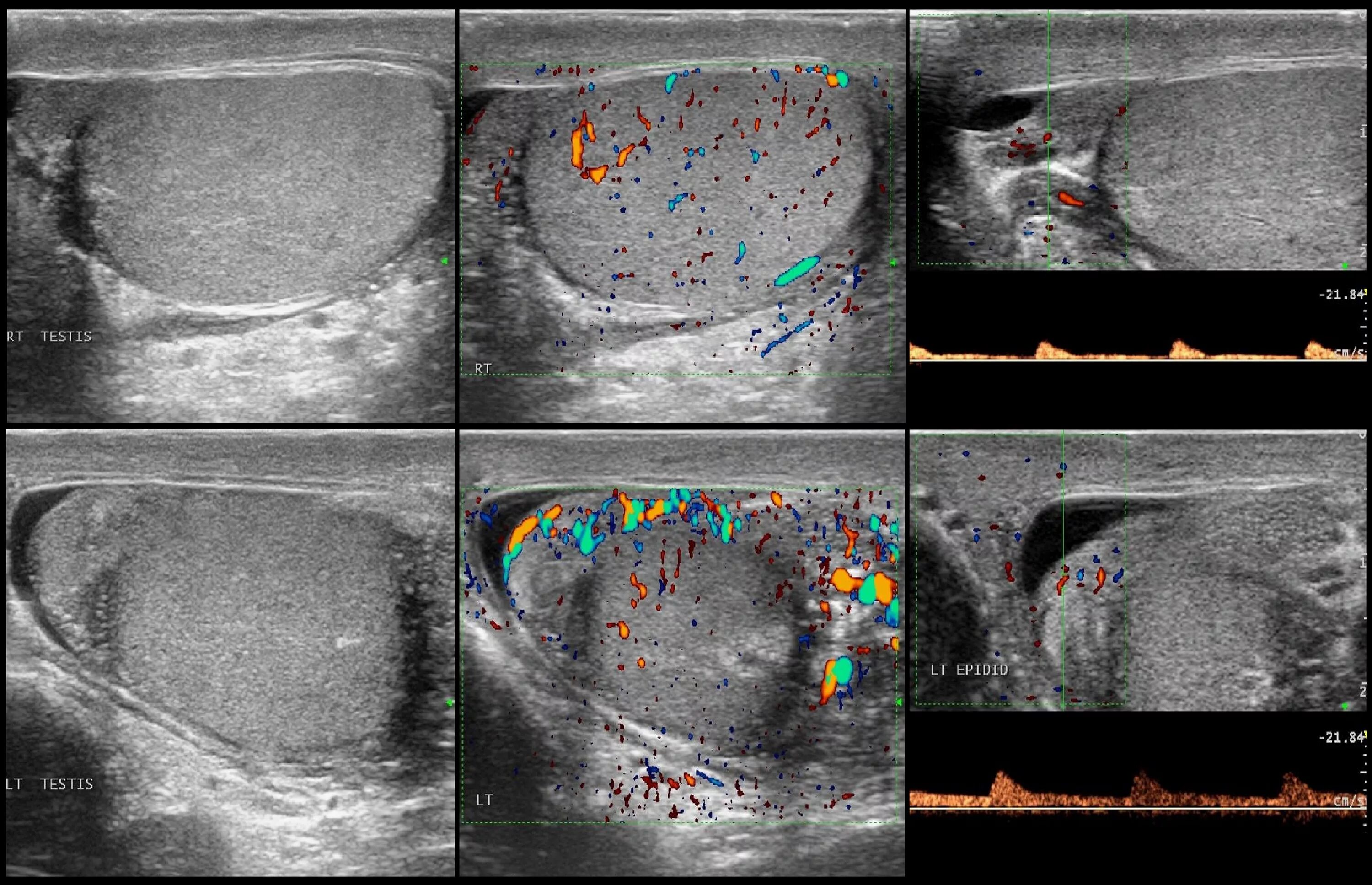 Воспаление семенного канатика у мужчин. Перекрут яичка УЗИ картина. Перекрут придатка яичка УЗИ. УЗИ мошонки Диагностер.