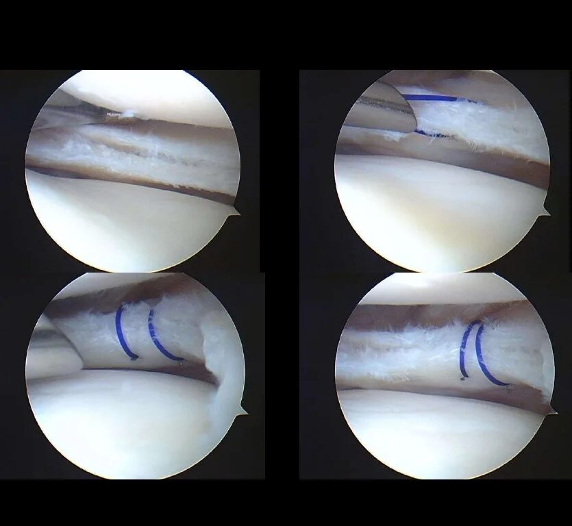 Типы разрывов мениска. Разрыв мениска визуально.