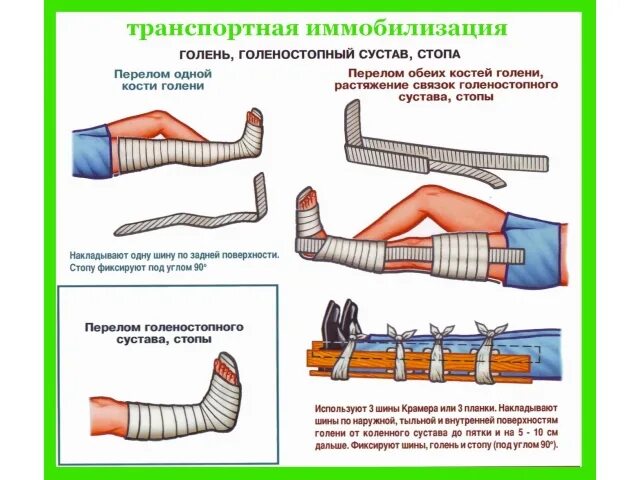 Алгоритм при переломе голени. Наложение шины крамера при переломе костей голени. транспортная иммобилизация шиной крамера.
