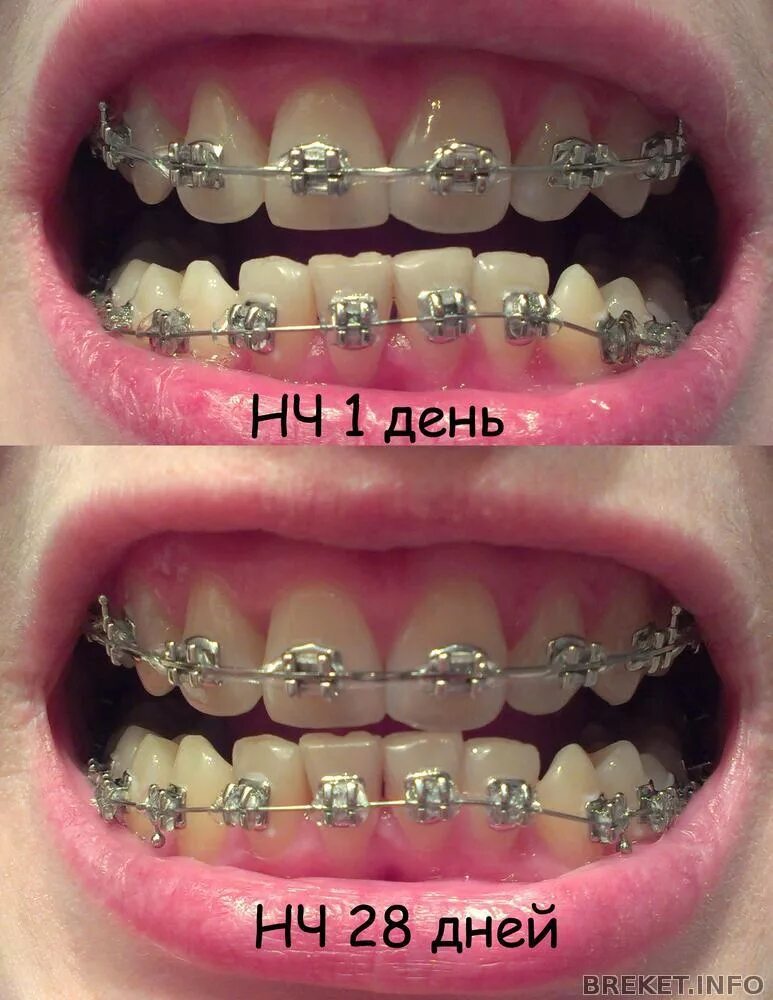 Можно есть чипсы с брекетами. Можно есть чипсы с брекетами