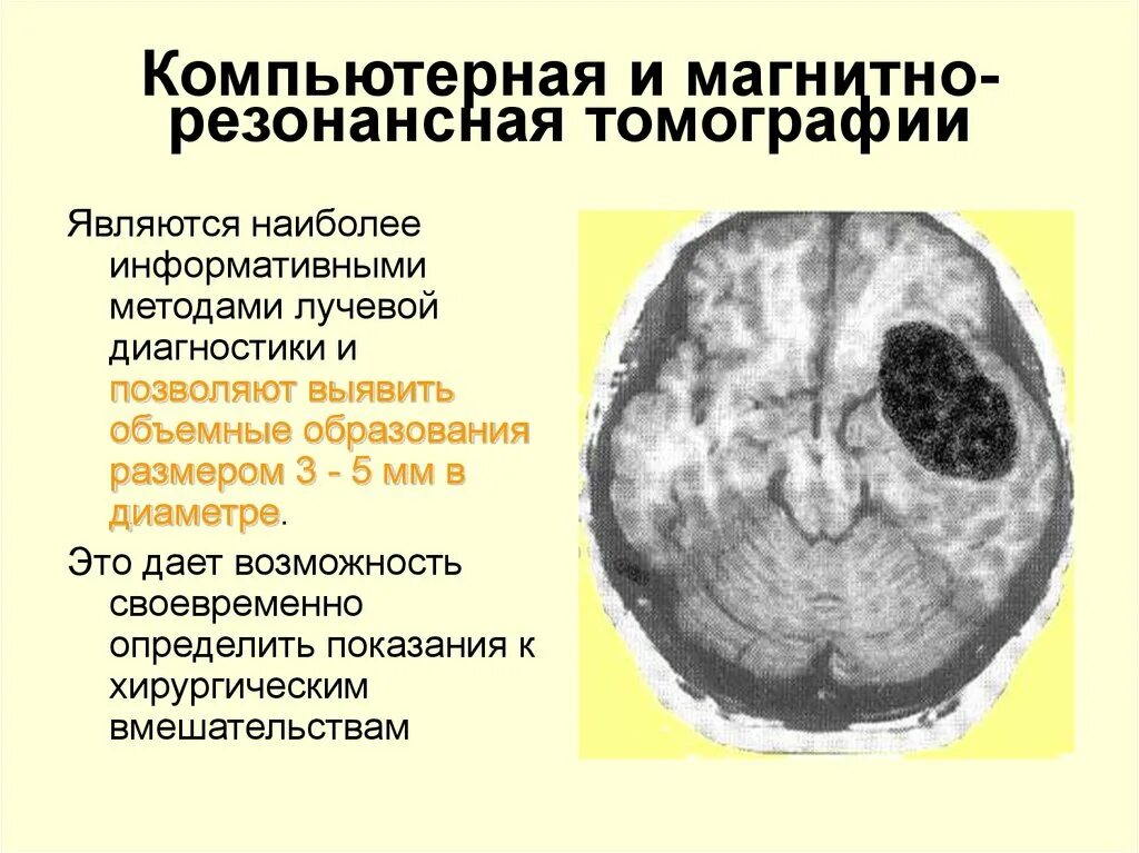 Симптомы опухоли головного мозга на ранних стадиях. Опухоль головного мозга стадии. Критерии злокачественности опухоли головного мозга. Опухоль головного мозга причины возникновения. Особенность доброкачественных опухолей головного мозга.