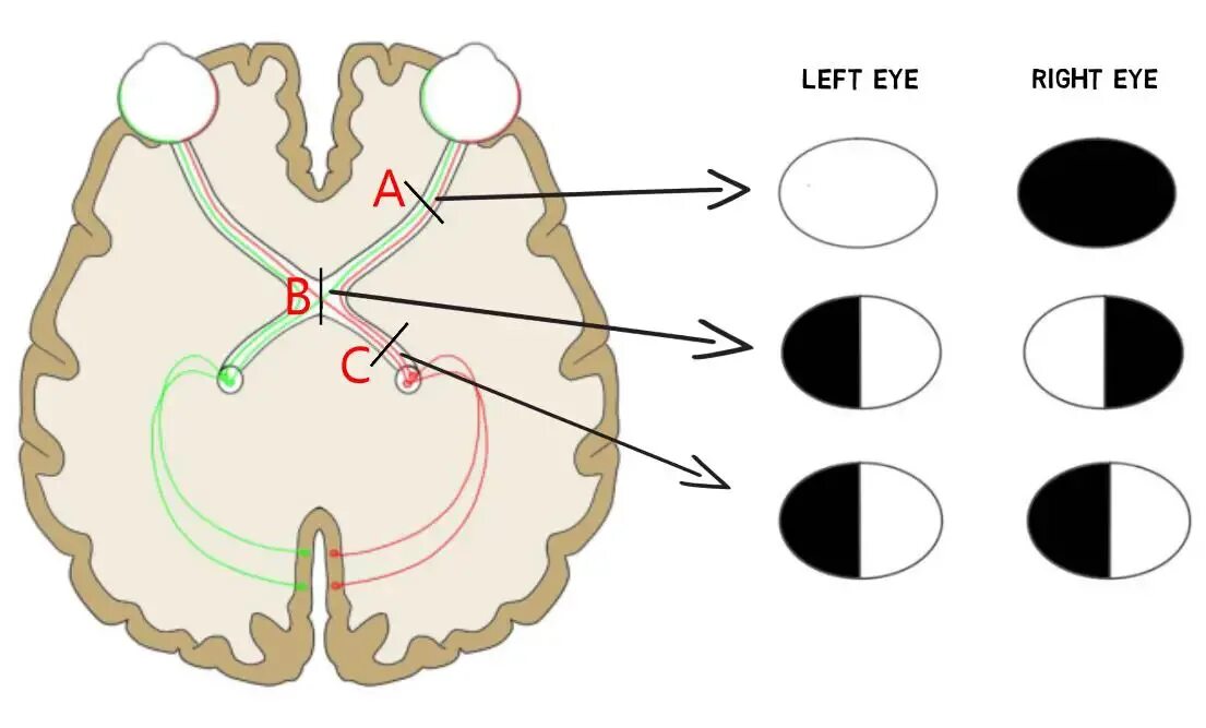Зрительный нерв в головной мозг. Топография зрительного нерва анатомия. Перекрест волокон зрительного нерва. Зрительный нерв нерв анатомия. Анатомия зрительного нерва мрт.