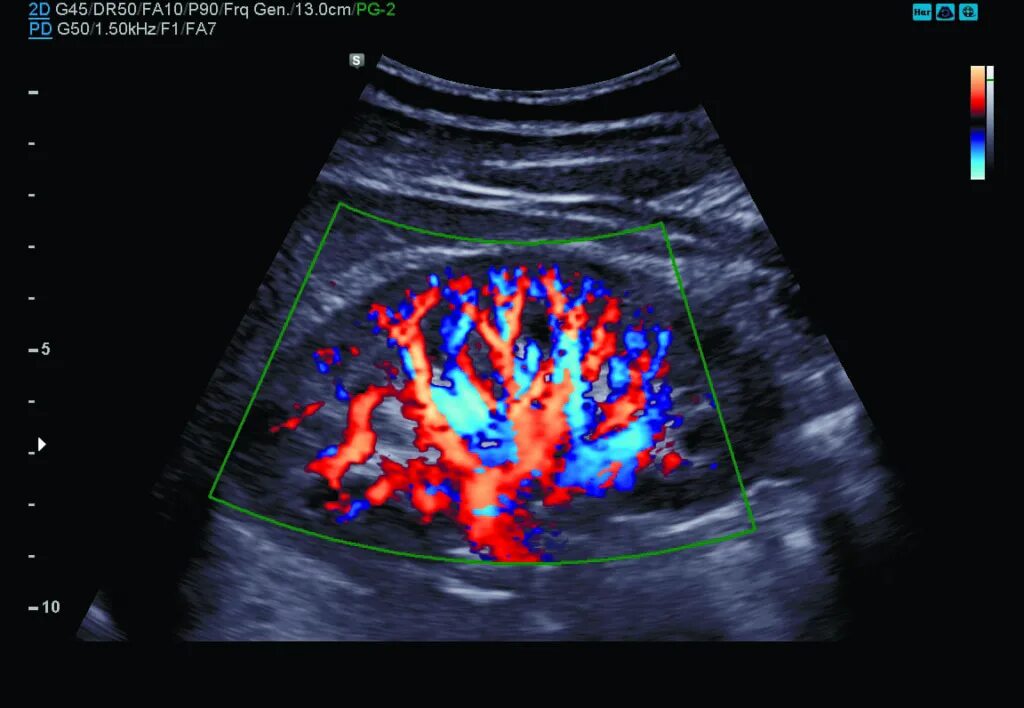 Допплерография ребенку. Допплерография сосудов почек УЗИ. Доплер УЗИ сосудов почек. УЗИ сосудов почки допплер. Допплеровское сканирование сосудов почек.
