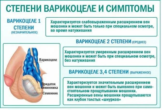 Расширение вен канатика. Варикозное расширение вен яичка у мужчин. Варикоцеле у мужчин симптомы.