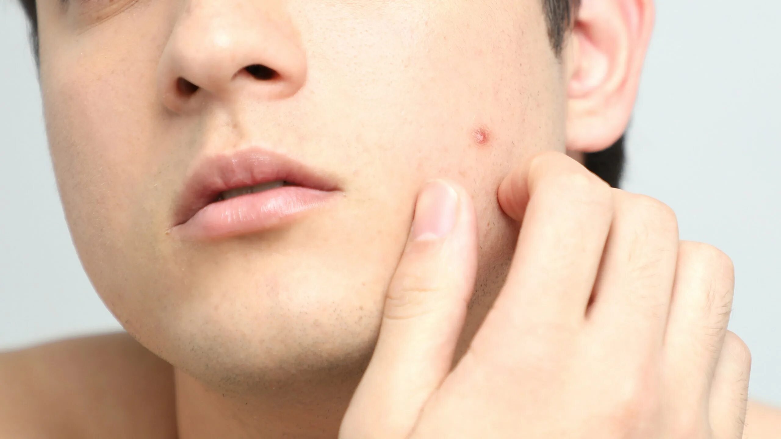 What Are Those Tiny White Bumps Under Your Eyes? Tipos de acné, Granos en la fre