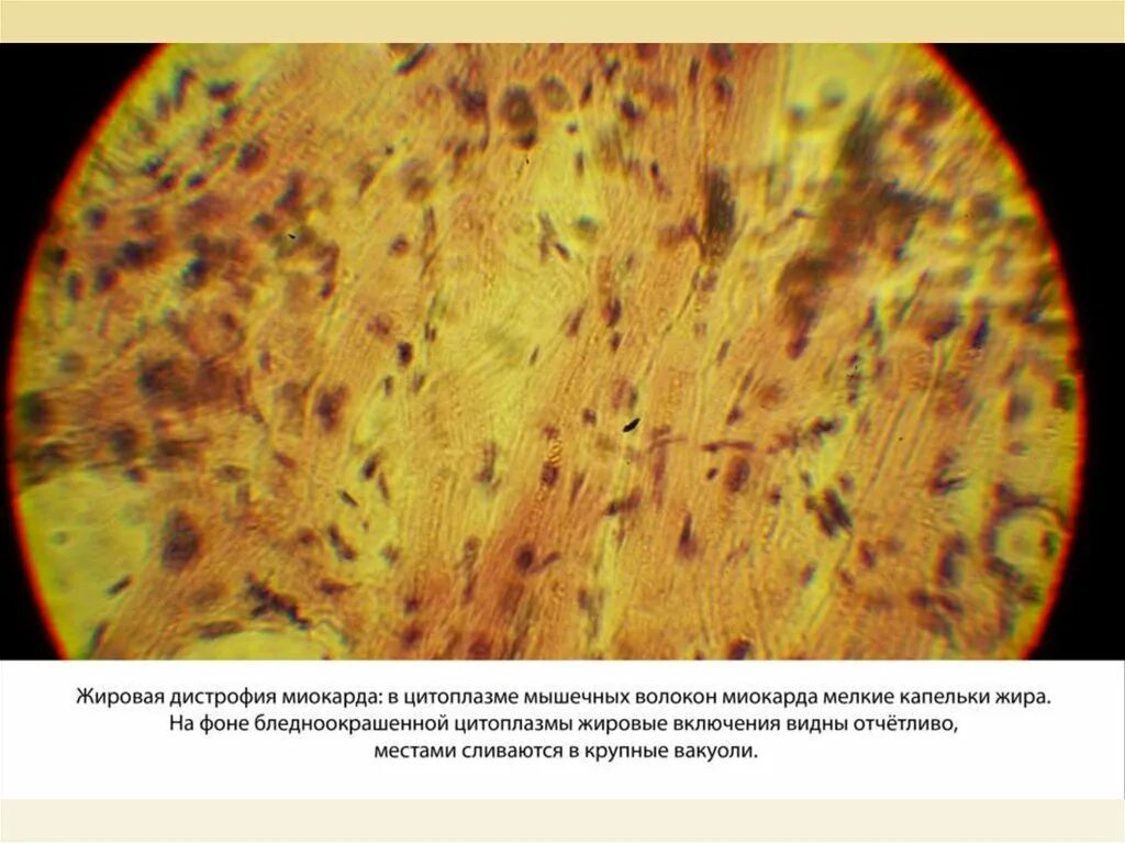Жировая дистрофия кардиомиоцитов гистология. Паренхиматоз дистрофия. Дистрофия макропрепарат. Дистрофия микроскопия.