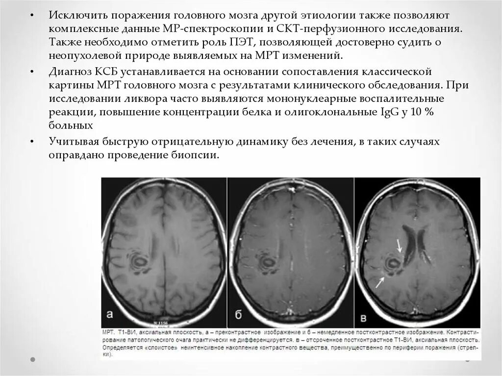 Полное поражение головного мозга. ПМЛ мрт прогрессирующая мультифокальная лейкоэнцефалопатия. Прогрессирующая лейкоэнцефалопатия мрт. Мультифокальная лейкоэнцефалопатия мрт. Мультифокальное поражение головного мозга мрт.