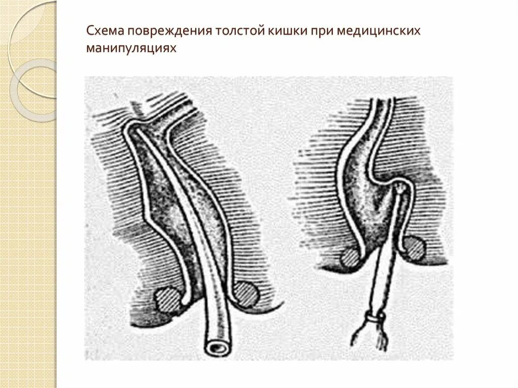 Повреждения прямой кишки. Внебрюшинное повреждение прямой кишки. Повреждения и инородные тела прямой кишки. Механические травмы прямой кишки.