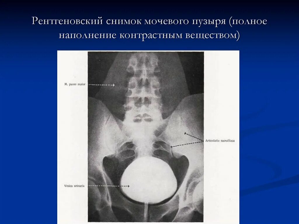 Рентгеновские снимки мочевого пузыря. Прицельная рентгенограмма мочевого пузыря.