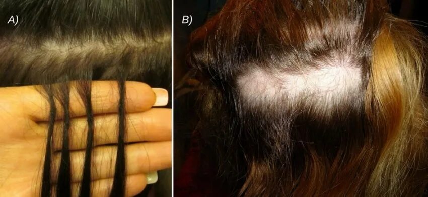 После снятия наращивания. Волосы после наращивания. Наращивание волос до и после. Волосы после капсульного наращивания. Волосы на капсулах до после.