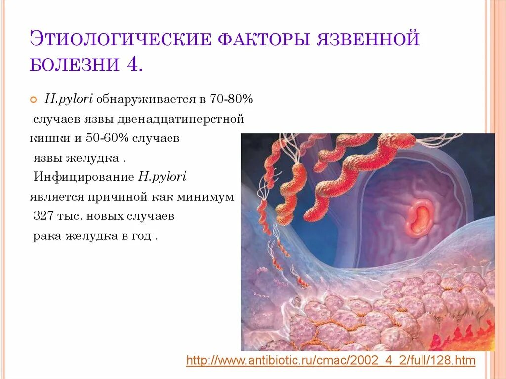 Причины язвенной болезни желудка. Этиологические факторы язвенной болезни. факторы язвенной болезни желудка и двенадцатиперстной кишки. ведущий этиологический фактор язвенной болезни.