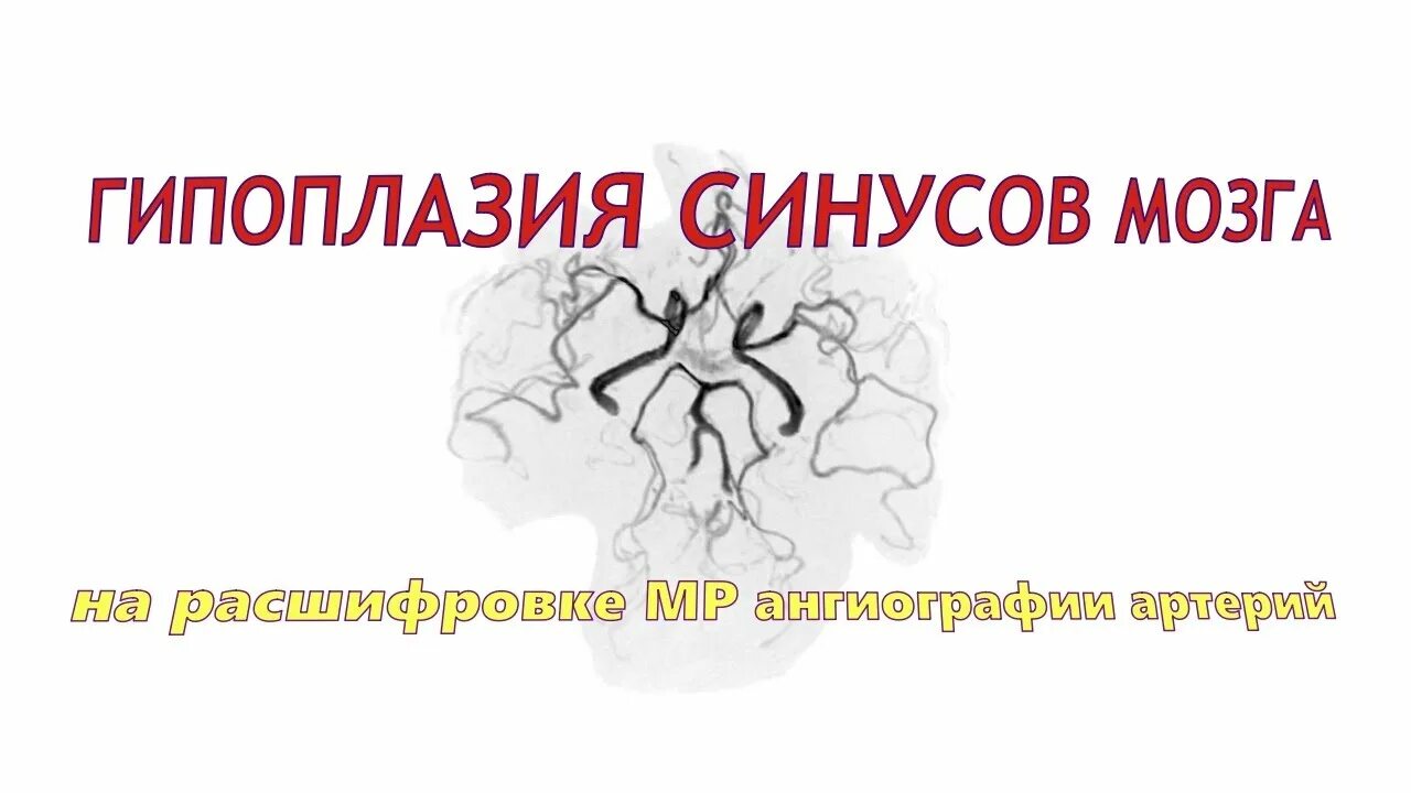 Гипоплазия синусов головного мозга. Гипоплазия артерии мозга. Гипоплазия правого поперечного синуса головного мозга. Асимметрия поперечных и сигмовидных синусов головного мозга. Гипоплазия правой артерии мозга