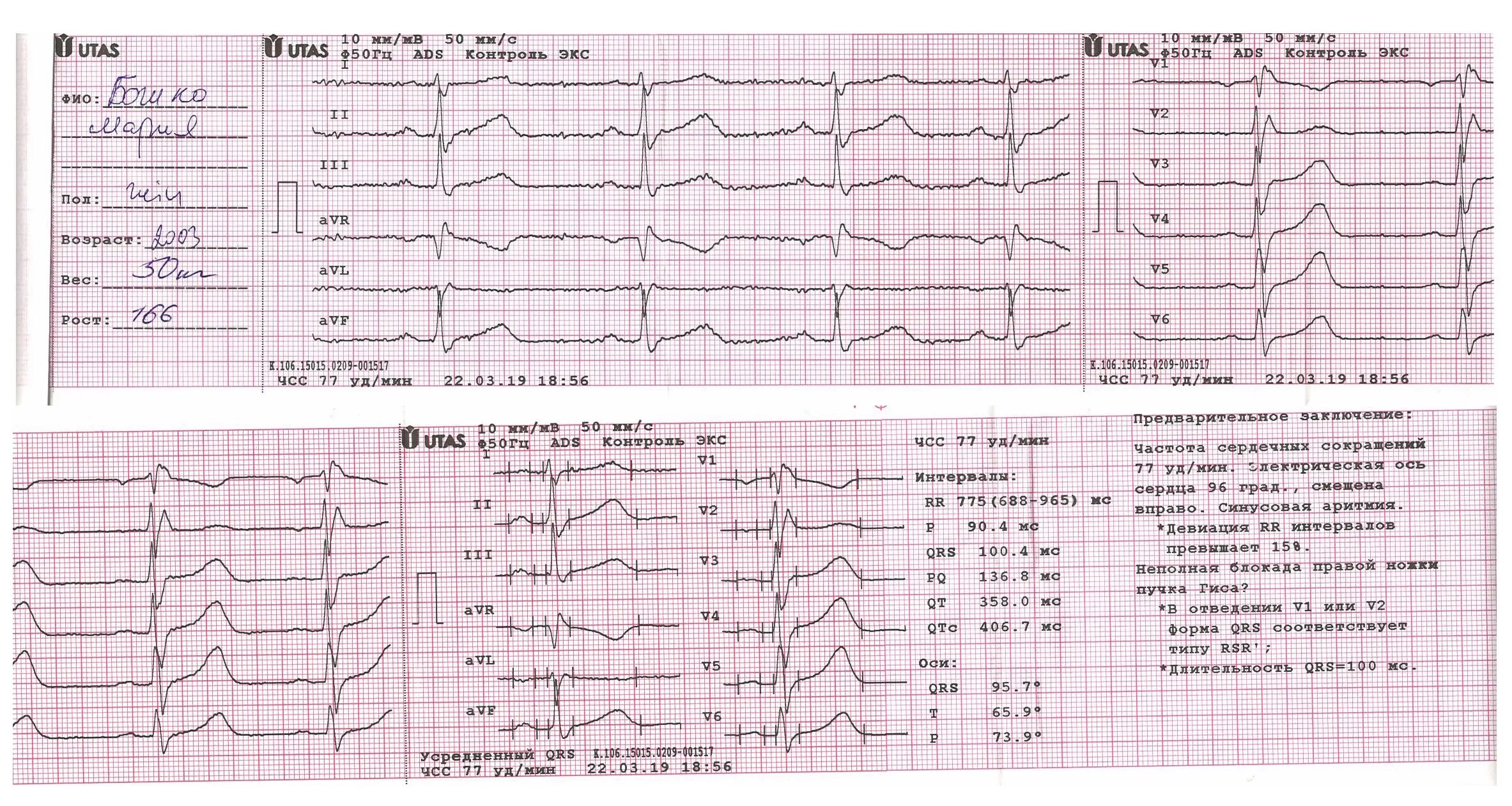 Кардиограмма сердца норма показатели. QRS норма ЭКГ. ЭКГ P(MS) 105. ЭКГ зубец р в норме и при патологии. Тяжелое экг