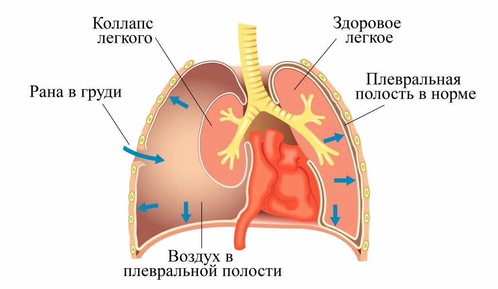 Спадение бронха