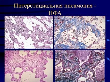 Интерстициальная пневмония