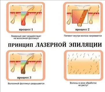 Лазерная эпиляция подготовка к процедуре