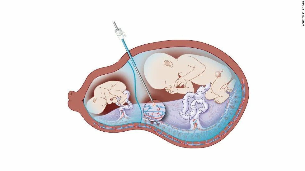 Редукция эмбриона при многоплодной беременности. Рисунок художника плацента. Селективная редукция одного плода из двойни.