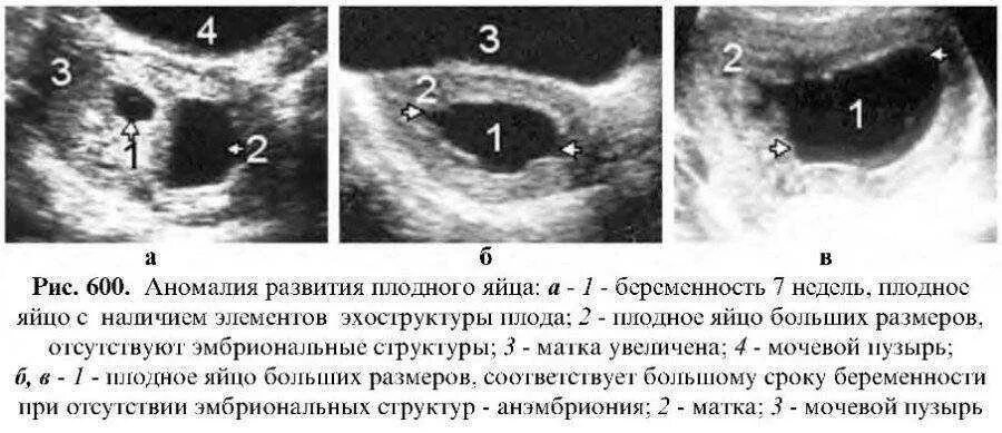 Плодное яйцо при беременности 5 6 недель. Плодное яйцо на УЗИ 5 недель. Плодное яйцо на 5-6 неделе беременности. Плодное яйцо на раннем сроке Размеры.