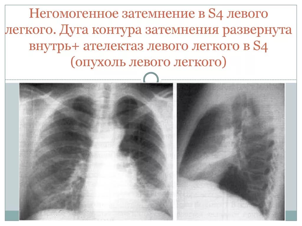 Затемнение в левом легком