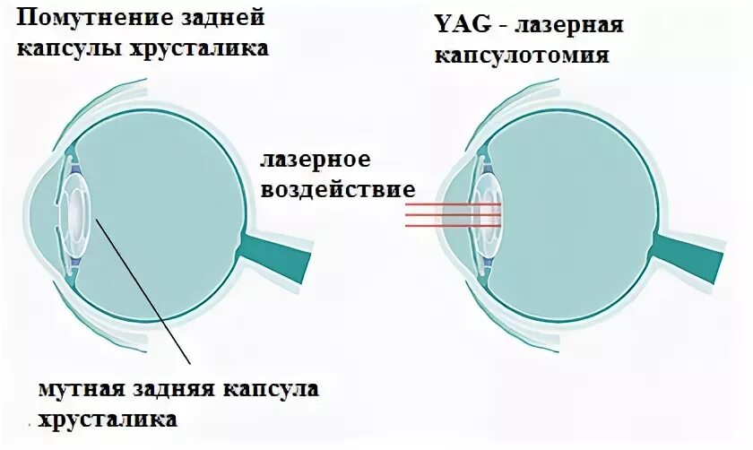 лазерная корепраксия, дисцизия задней капсулы хрусталика. строение человеческого глаза хрусталик. строение хрусталика глаза анатомия. катаракта хрусталик строение. схема строения хрусталика гистология.
