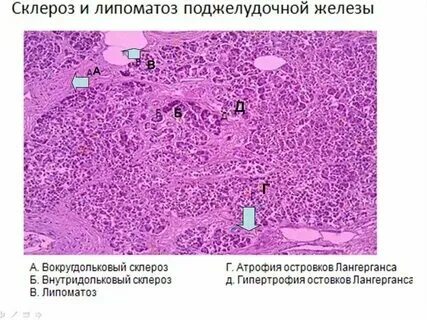 Что такое липоматоз поджелудочной железы 1 степени