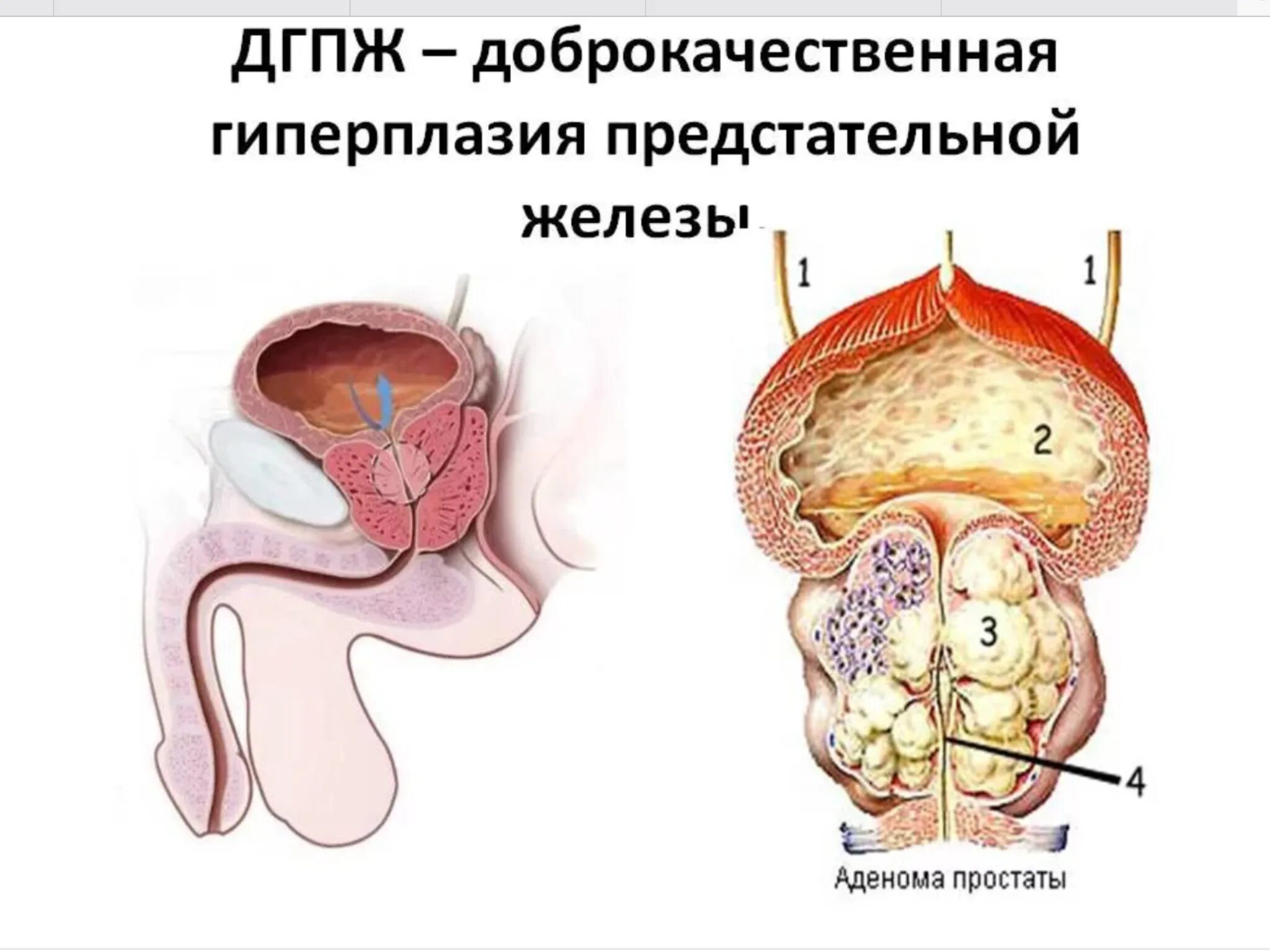 Полная простата