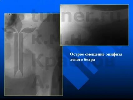 Эпифизеолиз код мкб