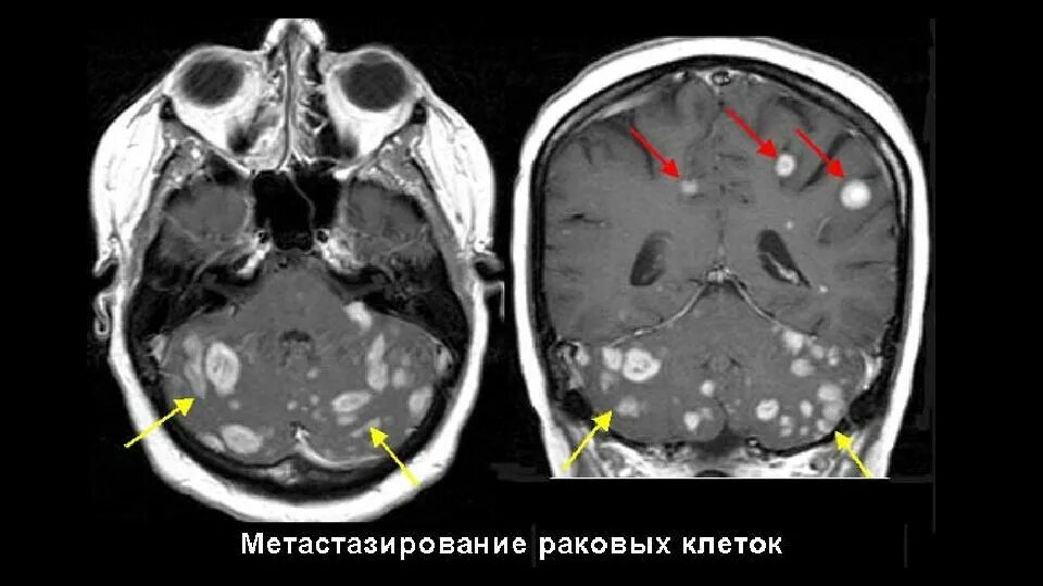 Лечение метастазов мозга. Вторичные Метастатические опухоли головного мозга. Опухоль головного мозга метастазы. Томограмма опухоли головного мозга. Метастазы головного мозга мрт.