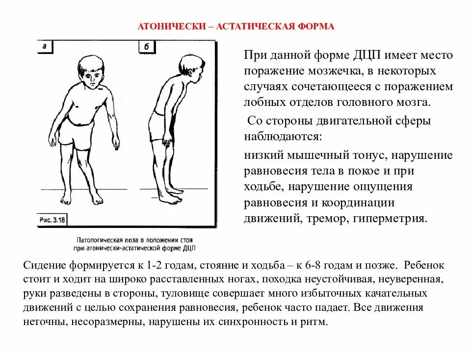 Дцп атонически астатическая. Атонически-астатическая форма дцп. детский церебральный паралич атонически-астатическая форма. дцп атонико-астатическая форма симптомы. атаксическая форма дцп.
