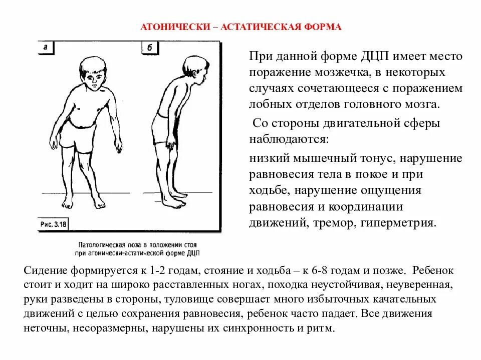 Дцп атонически астатическая. Атонически-астатическая форма ДЦП. Детский церебральный паралич атонически-астатическая форма. ДЦП атонико-астатическая форма симптомы. Атаксическая форма ДЦП.