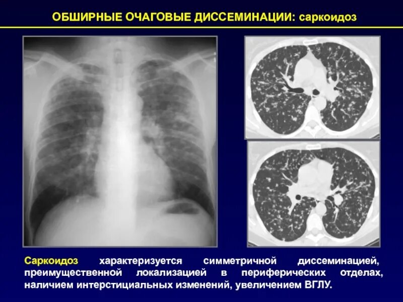 Диссеминированный синдром рентген. Синдром диффузной диссеминации рентген. Саркоидоз диссеминация. Синдром диссеминации на рентгенограмме. Диффузные изменения в легких