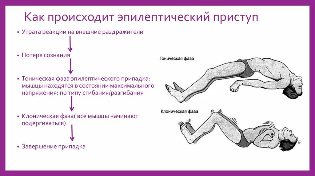 Фазы судорожного припадка при эпилепсии. Характерные симптомы эпилептического припадка. Клинические проявления эпилепсии характеризуются. Эпилепсия ,понятие, основные клинические проявления. Как называется эпилепсия