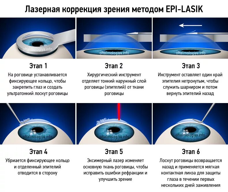 Чем толще линза тем. Этапы лазерной коррекции зрения ласик. Лазерная коррекция зрения методом ласик. Лазерная коррекция зрения ласик ФРК. Лазерная коррекция зрения Femto ласик.