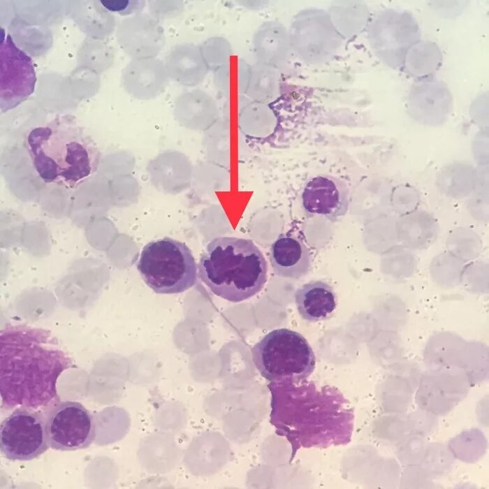 Пролимфоцит гистология. Миелоцит микроскопия. Миеломная болезнь мазок крови. Лимфоциты под микроскопом. Лимфоциты под микроскопом.