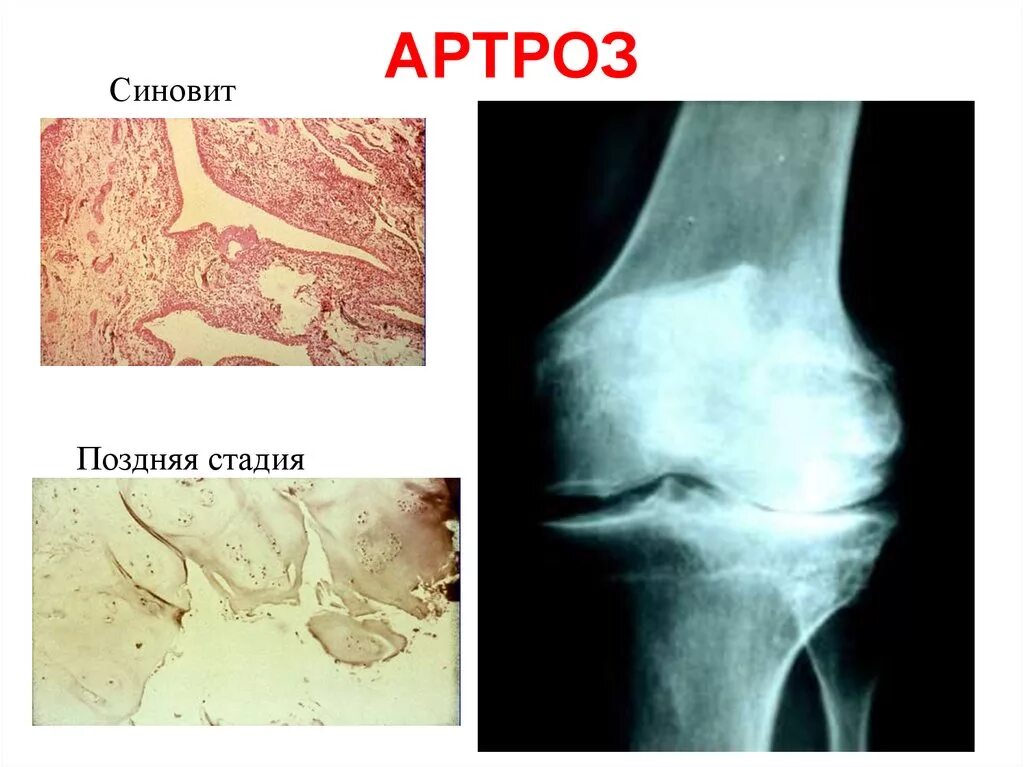 Синовит артроз коленного сустава. Умеренный синовит коленного сустава.