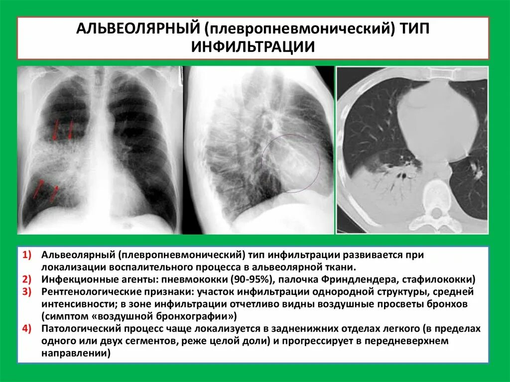 Интерстициальная инфильтрация на рентгене. Альвеолярный Тип инфильтрации при пневмонии рентген. Симптомы воспалительной инфильтрации лёгочной. Инфильтрация и пневмония рентген.