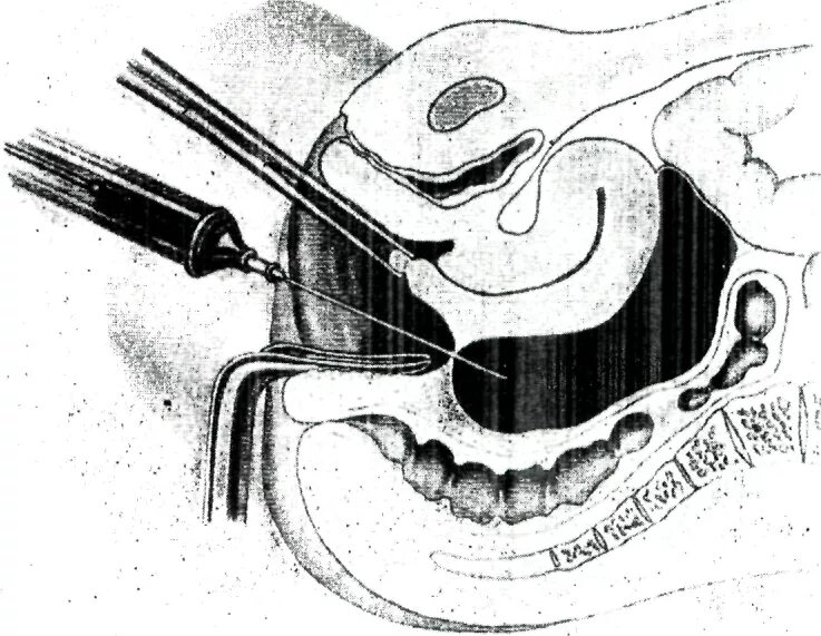 Результаты выскабливания. Пункция заднего свода матки. Выскабливание цервикального канала шейки. Выскабливание полости матки пункция заднего свода. Задний свод шейки матки.