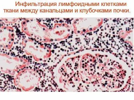 Лимфоидная инфильтрация