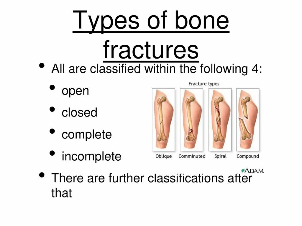 Перелом кости может быть каким. Названия переломов костей. Неполный перелом кости.