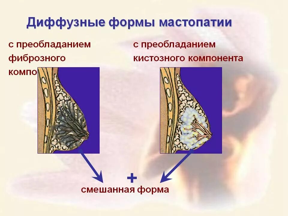 Фиброзно-кистозная мастопатия диффузная Узловая. Фиброзная мастопатия молочной железы что это. Диффузная, диффузно-Узловая, фиброзно- кистозная, Узловая мастопатия. Диффузная кистозная мастопатия. Диффузно фиброзные изменения молочных желез