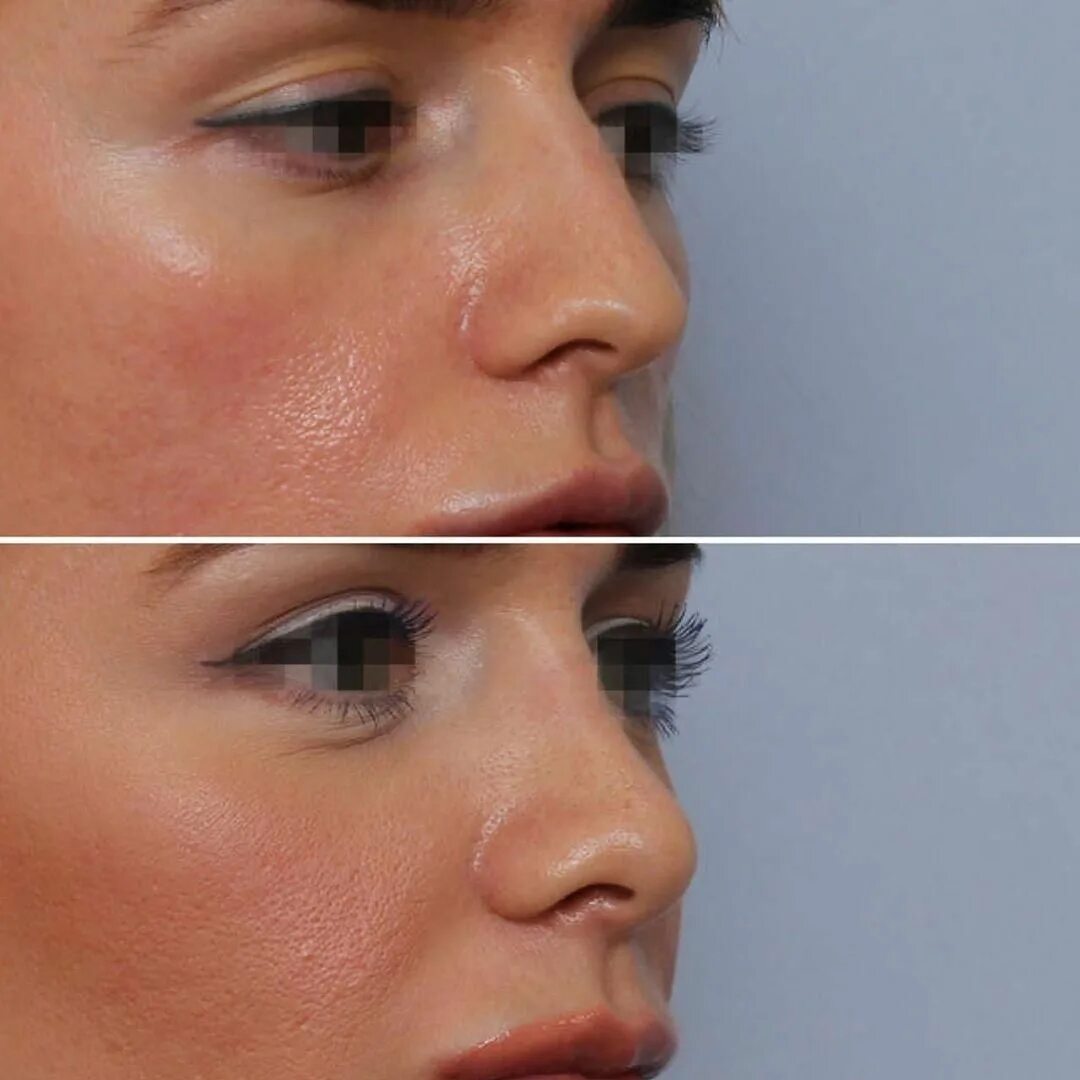 нос с помощью филлера. аугментационная ринопластика. нос с помощью филлера. бейби нос ринопластика. безоперационная пластика носа.