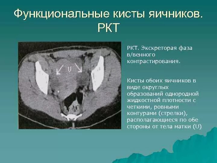 Киста яичника на мрт. Фолликулярная киста яичника на кт. Образование яичника на кт. Кистозные образования яичников на кт.