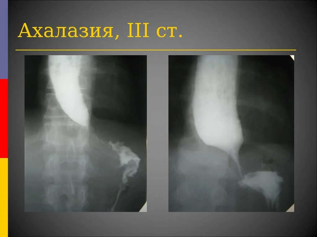 Халазия пищевода. Ахалазия Кардия рентген. Ахалазия желудка рентген. Ахалазия рентген признаки. Ахалазия пищевода рентгенодиагностика.