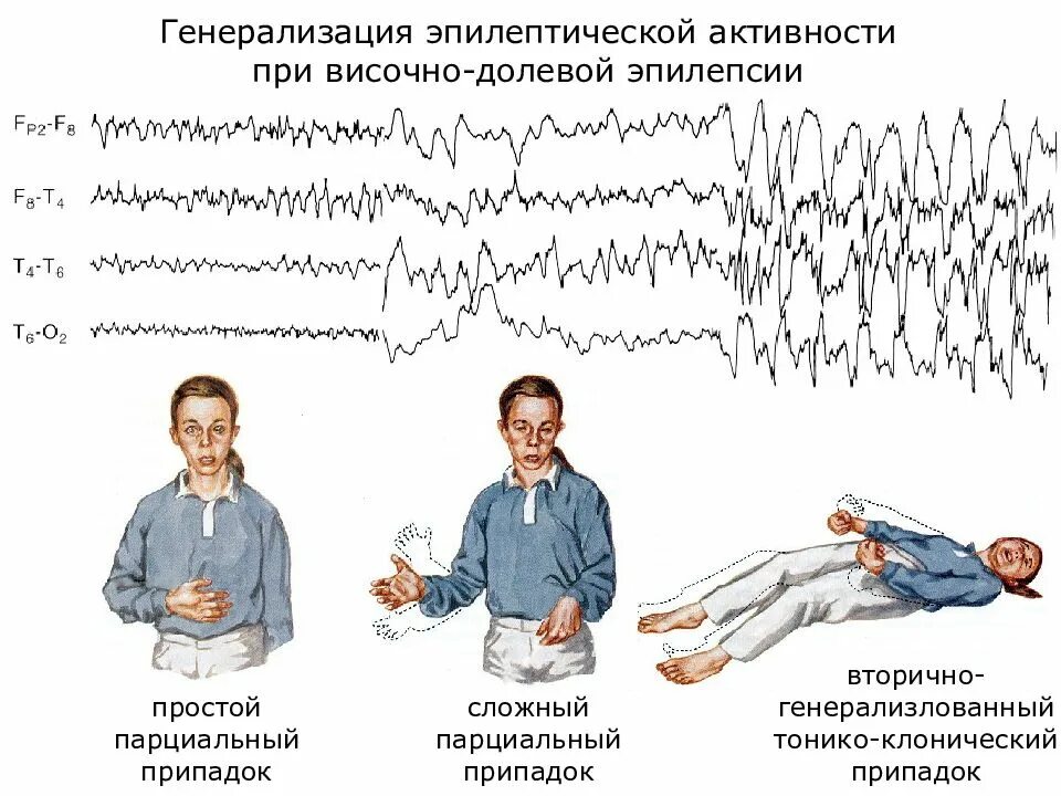 Синдромы при эпилепсии. Парциальные и генерализованные припадки. Парциальные и генерализованные эпилептические припадки. Парциальные тонико клонические припадки абсансы. Приступ эпилепсии симптомы.