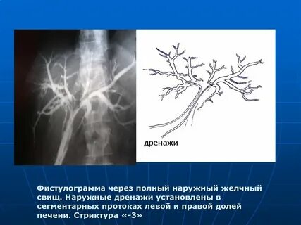 Желчные свищи
