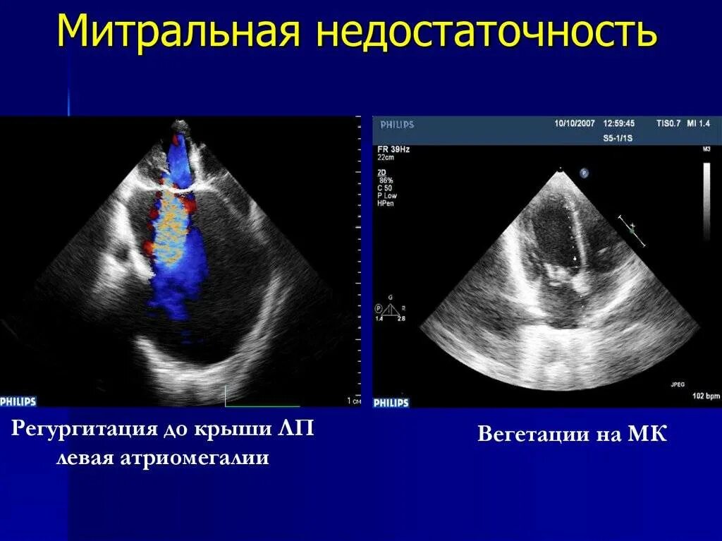 Аортальная недостаточность узи. Пролапс митрального клапана на эхокг. Створки митрального клапана на узи сердца. Вегетации на клапане аортальном на узи. Эхокардиография сердца регургитация.