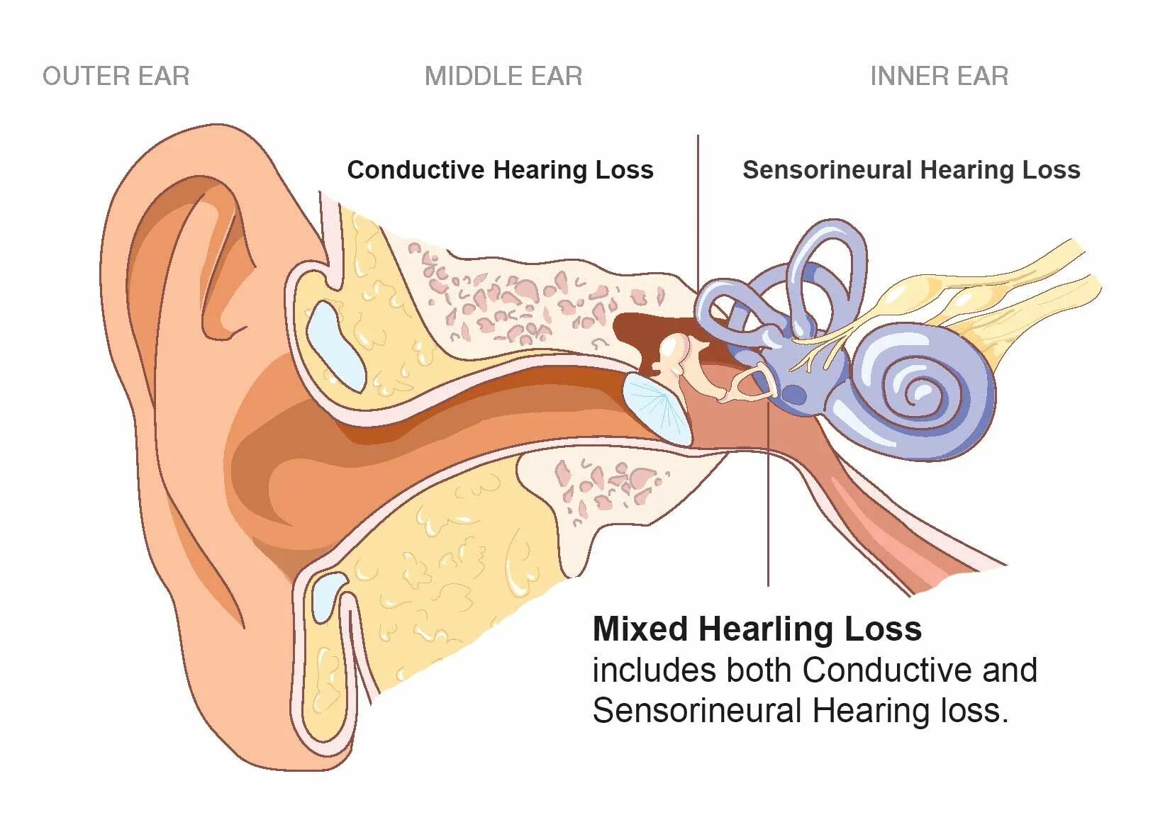 Hearing loss рисунок. Sensorineural hearing loss.