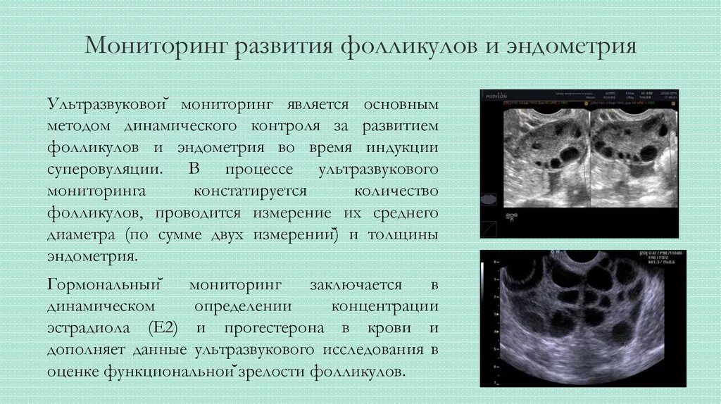 Какого размера должны быть фолликулы. УЗИ мониторинг фолликулов. Антральные фолликулы.