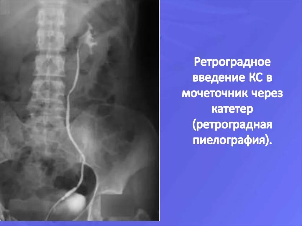 Катетеризация мочеточника. Ретроградная пиелограмма. Ретроградная пневмопиелография. Введение катетера в мочеточник пиелография. Ретроградная пиелография показания.